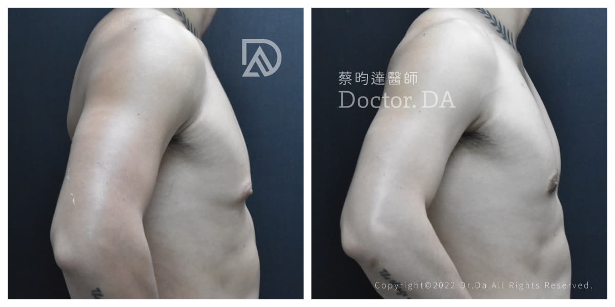 蔡昀達醫師男性女乳症案例照_90度