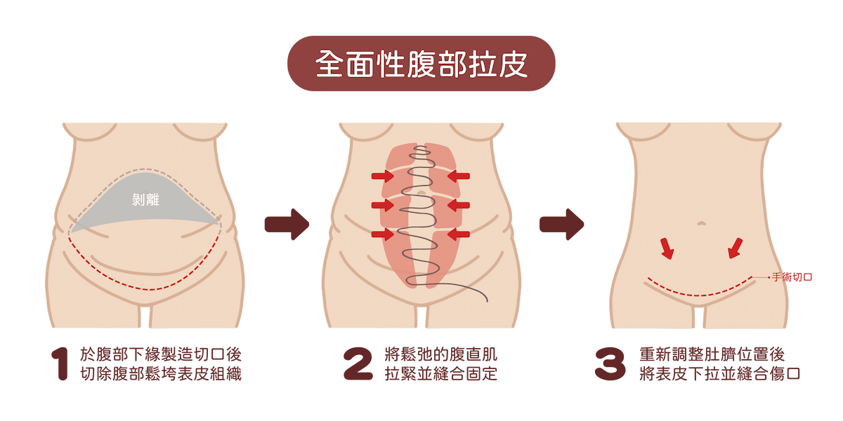 全面性腹部拉皮手術方式