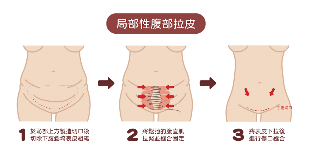 局部性腹部拉皮手術方式