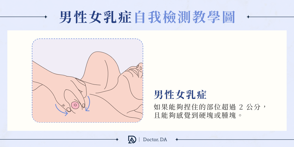 男性女乳症自我檢測教學 捏住乳暈判斷硬塊