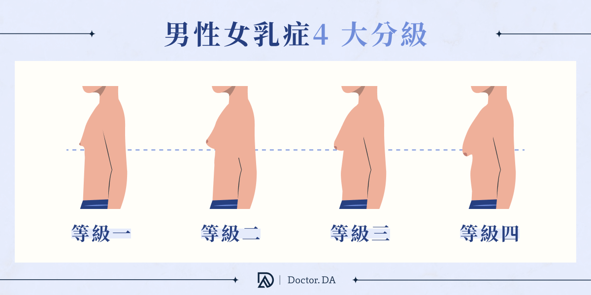 男性女乳症4大分級示意圖