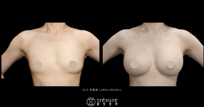 珍珠波隆乳案例 L390cc/R430cc