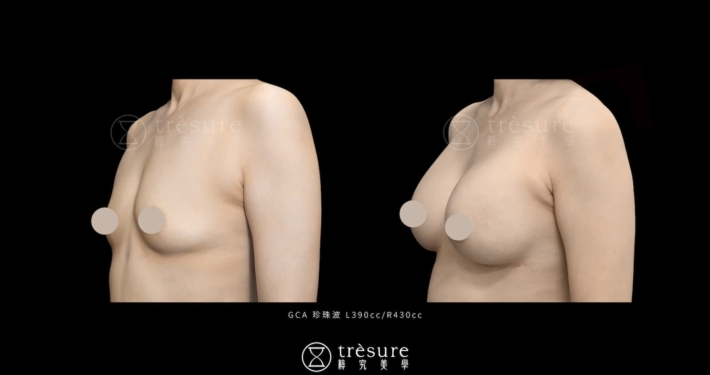 珍珠波隆乳案例 L390cc/R430cc