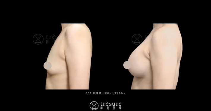 珍珠波隆乳案例 L390cc/R430cc