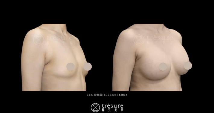珍珠波隆乳案例 L390cc/R430cc