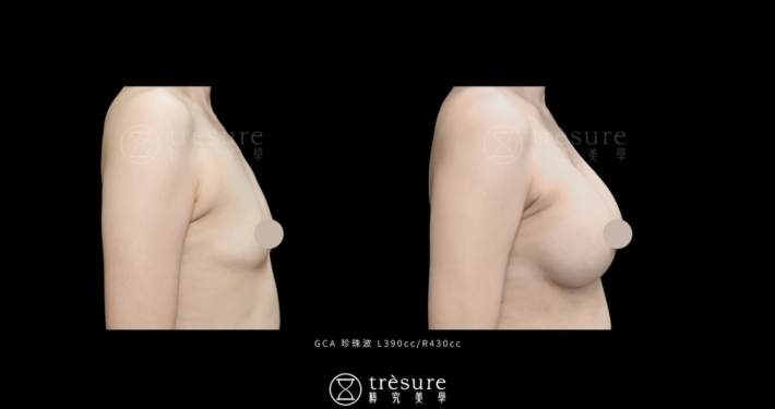 珍珠波隆乳案例 L390cc/R430cc