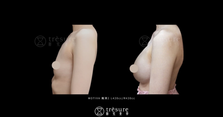 M2607006-3 魔滴2.0隆乳案例 L420cc/R420cc