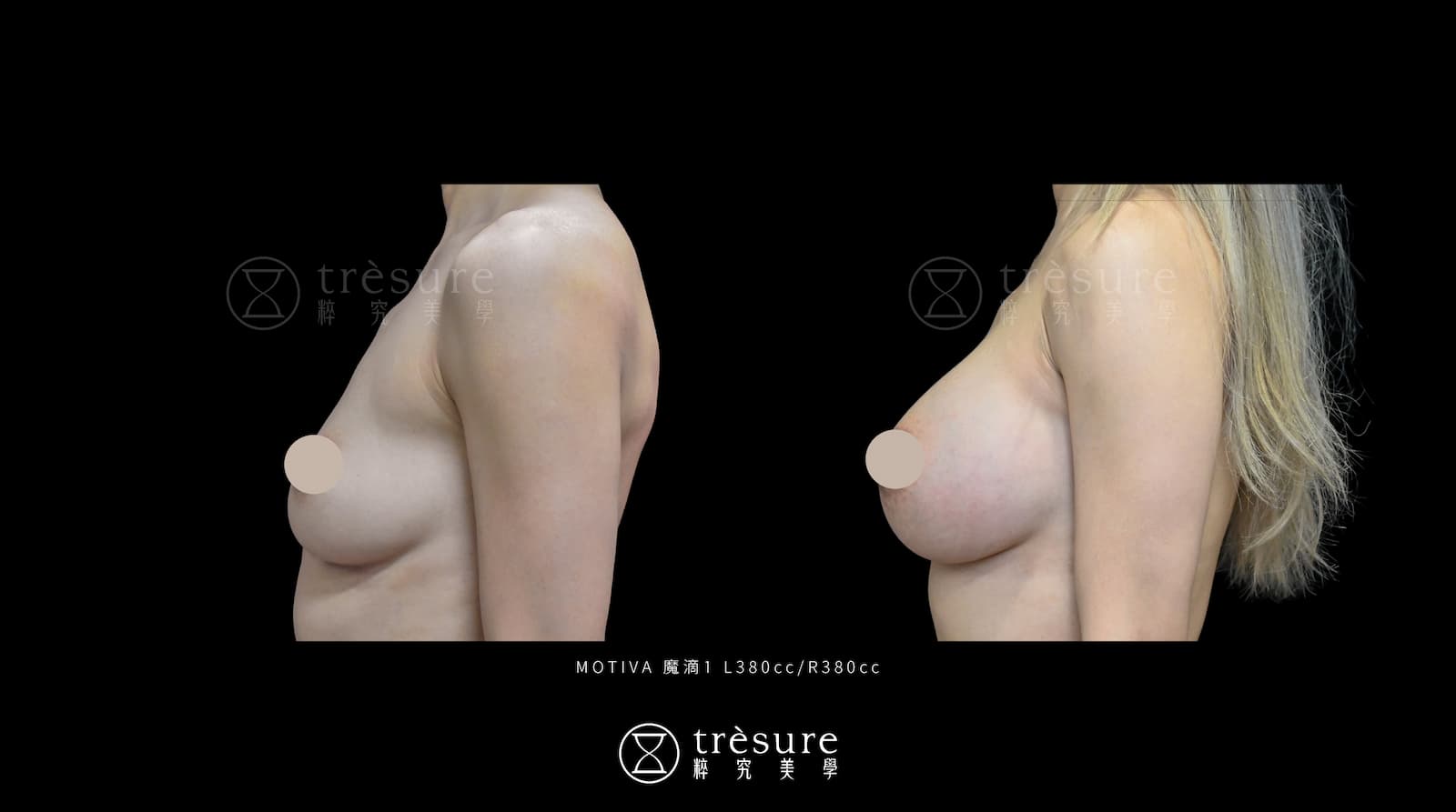 M2607009-3 魔滴隆乳案例 L380cc/R380cc