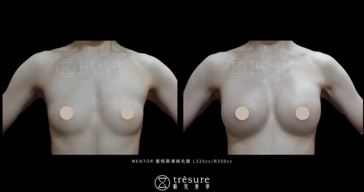 M2607010-1 蜜桃果凍絨毛隆乳案例 L325cc/R350cc