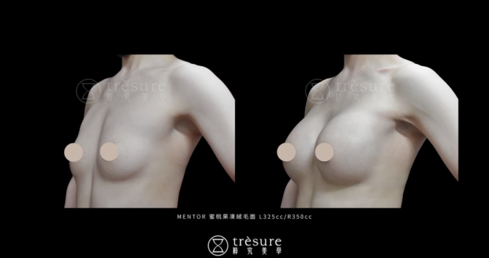 M2607010-2 蜜桃果凍絨毛隆乳案例 L325cc/R350cc
