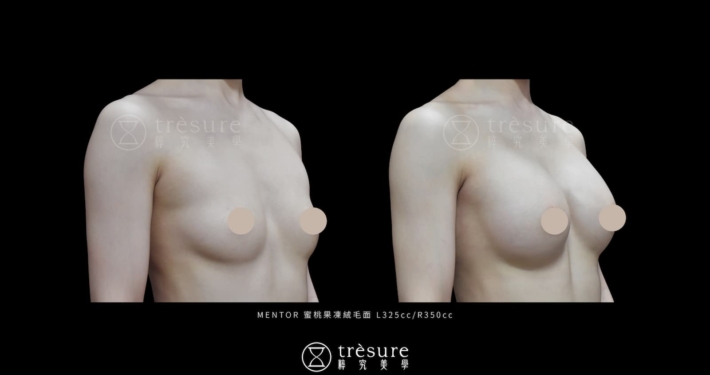 M2607010-4 蜜桃果凍絨毛隆乳案例 L325cc/R350cc