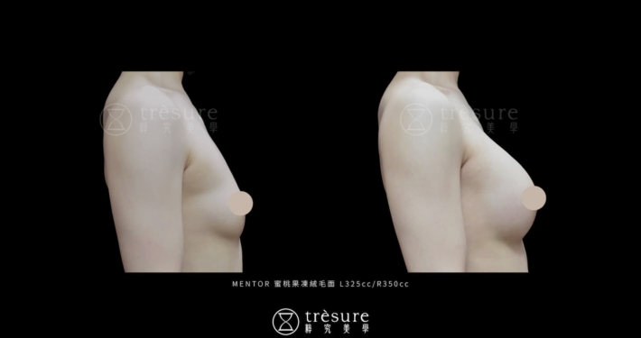 M2607010-5 蜜桃果凍絨毛隆乳案例 L325cc/R350cc