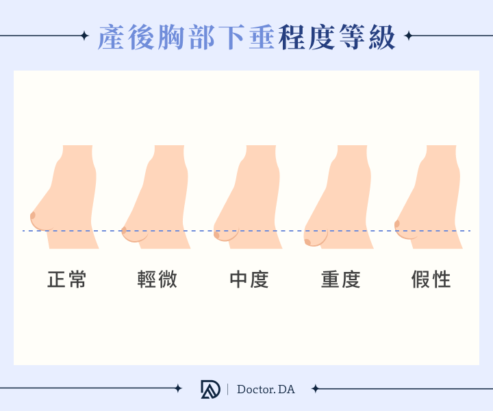 產後胸部下垂程度等級