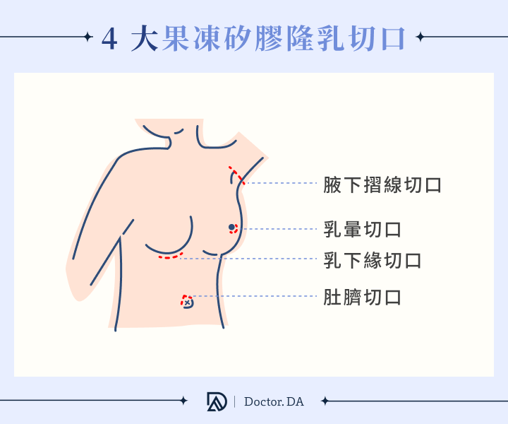 隆乳手術四大切口位置:乳暈、乳下緣、腋下與肚臍