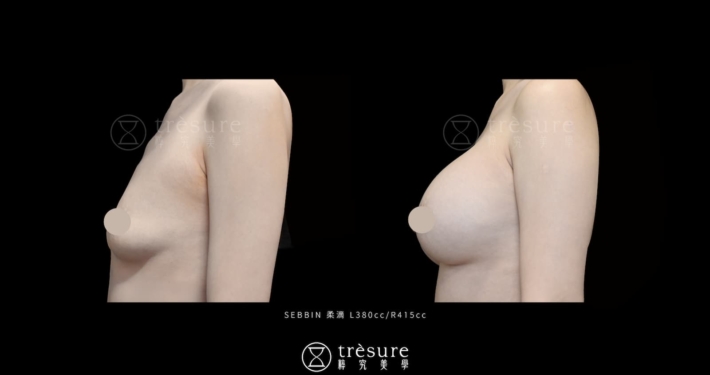 M2607008-3 柔滴隆乳案例 L380cc/R415cc